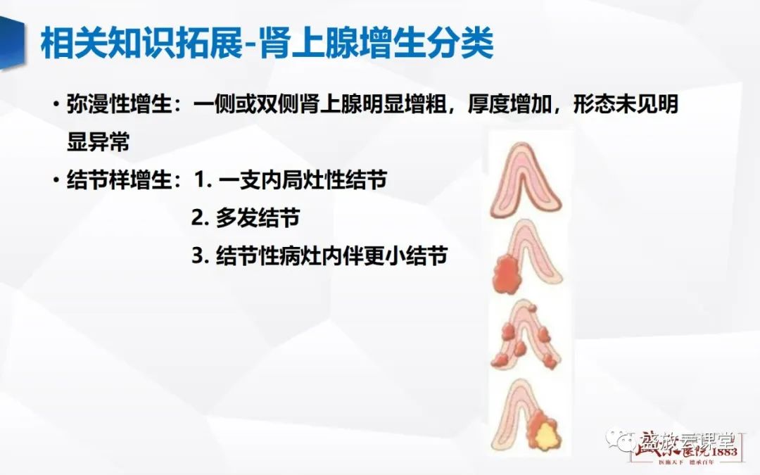 影像PPT - 【PPT】肾上腺增生 肾上腺腺瘤-20 影像PPT - 【PPT】肾上腺增生 肾上腺腺瘤-20