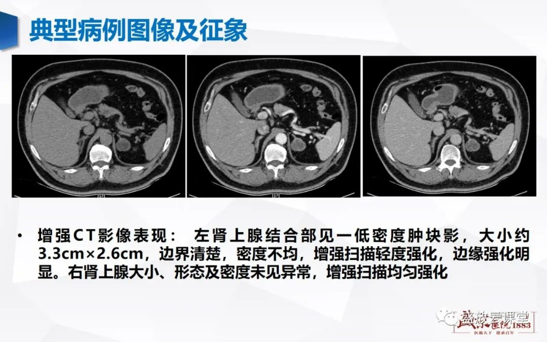 影像PPT - 【PPT】肾上腺增生 肾上腺腺瘤-22 影像PPT - 【PPT】肾上腺增生 肾上腺腺瘤-22