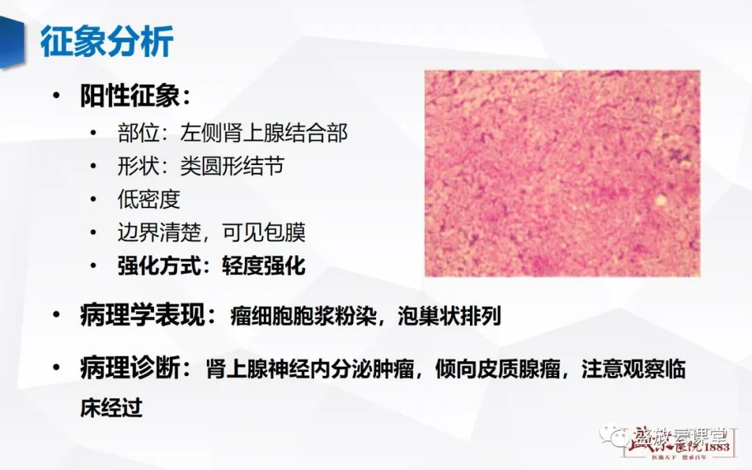 影像PPT - 【PPT】肾上腺增生 肾上腺腺瘤-24 影像PPT - 【PPT】肾上腺增生 肾上腺腺瘤-24