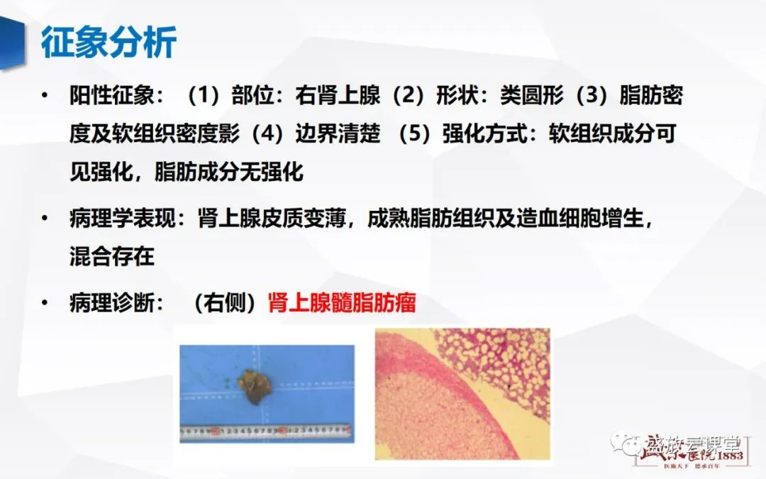 影像PPT - 【PPT】肾上腺增生 肾上腺腺瘤-28 影像PPT - 【PPT】肾上腺增生 肾上腺腺瘤-28