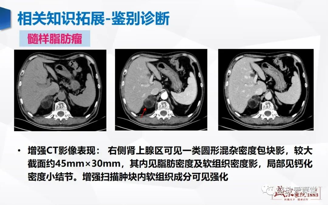 影像PPT - 【PPT】肾上腺增生 肾上腺腺瘤-27 影像PPT - 【PPT】肾上腺增生 肾上腺腺瘤-27
