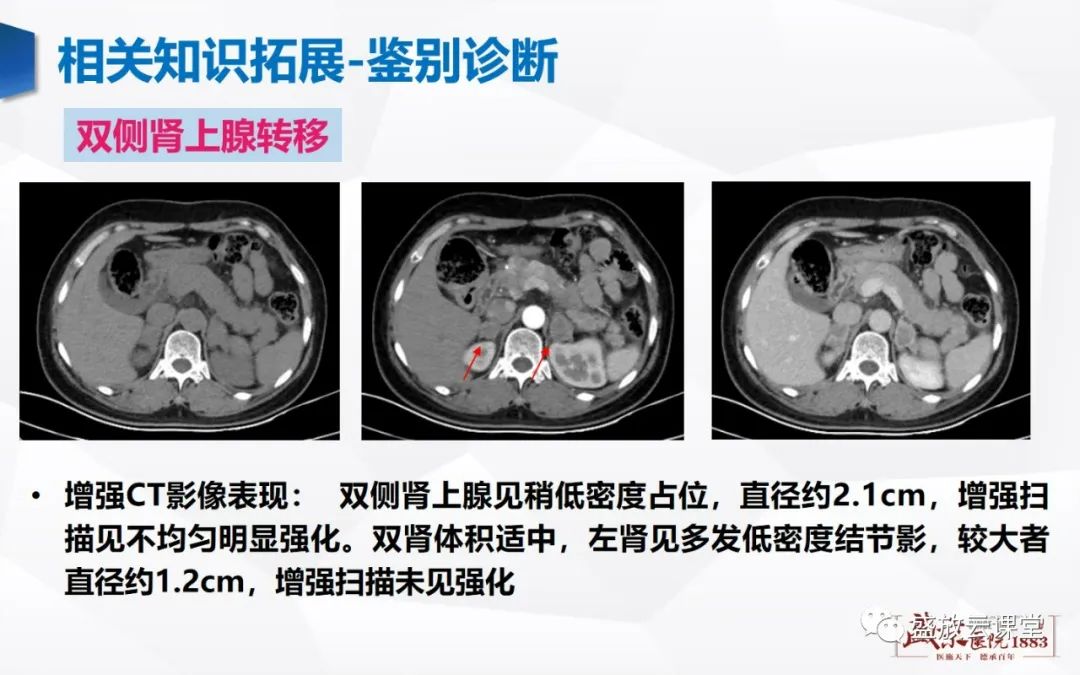 影像PPT - 【PPT】肾上腺增生 肾上腺腺瘤-31 影像PPT - 【PPT】肾上腺增生 肾上腺腺瘤-31