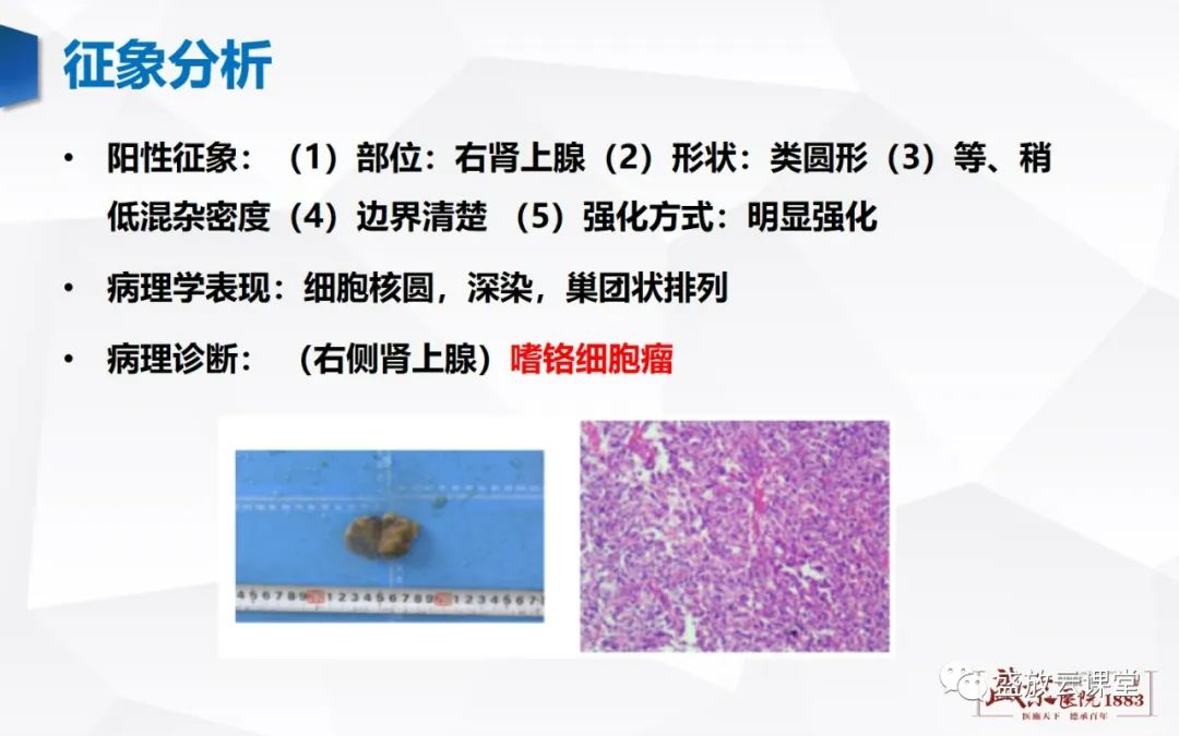 影像PPT - 【PPT】肾上腺增生 肾上腺腺瘤-30 影像PPT - 【PPT】肾上腺增生 肾上腺腺瘤-30