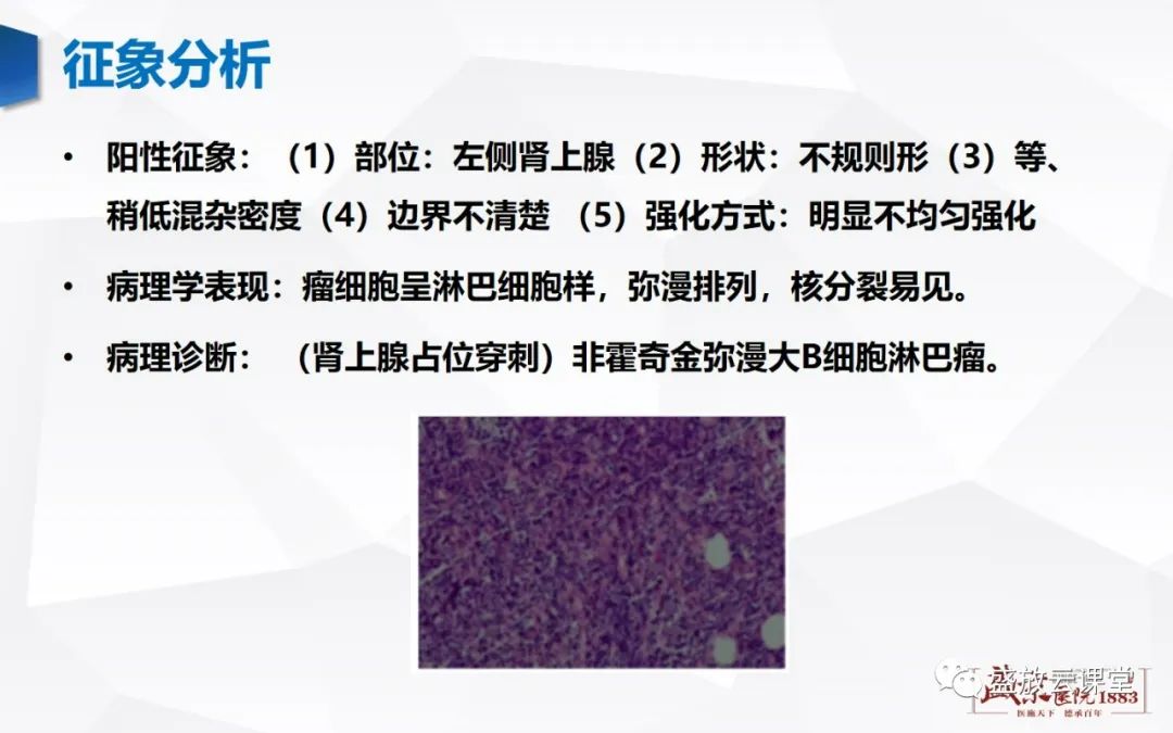 影像PPT - 【PPT】肾上腺增生 肾上腺腺瘤-34 影像PPT - 【PPT】肾上腺增生 肾上腺腺瘤-34