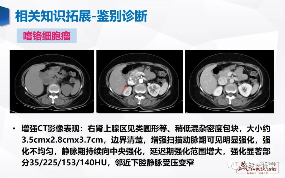 影像PPT - 【PPT】肾上腺增生 肾上腺腺瘤-29 影像PPT - 【PPT】肾上腺增生 肾上腺腺瘤-29