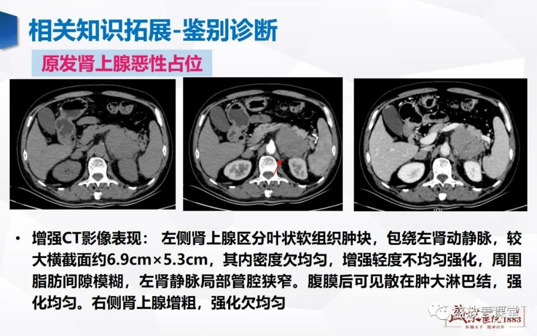 影像PPT - 【PPT】肾上腺增生 肾上腺腺瘤-33 影像PPT - 【PPT】肾上腺增生 肾上腺腺瘤-33