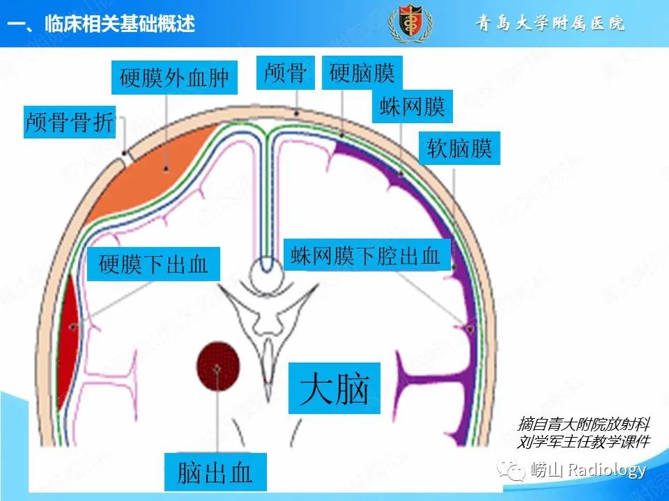 影像PPT - 【PPT】颅脑外伤性疾病-6