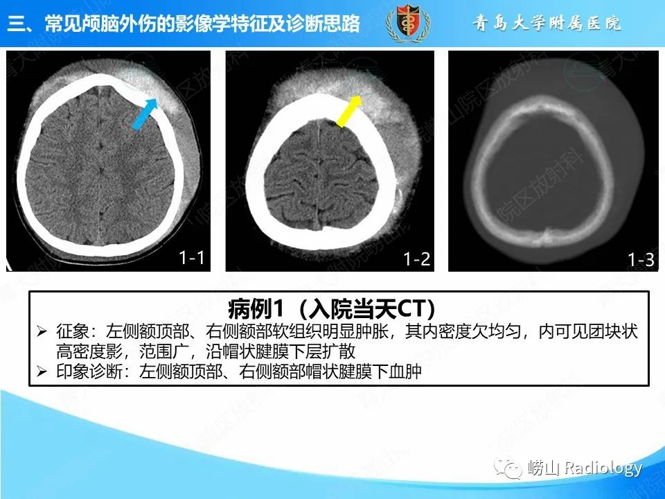 影像PPT - 【PPT】颅脑外伤性疾病-15
