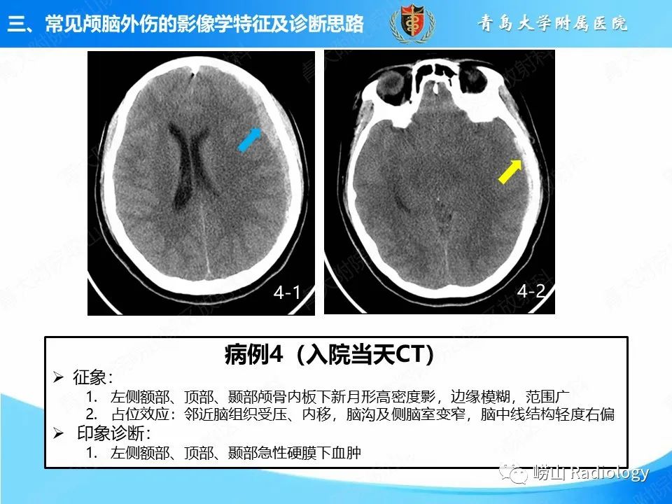 影像PPT - 【PPT】颅脑外伤性疾病-25