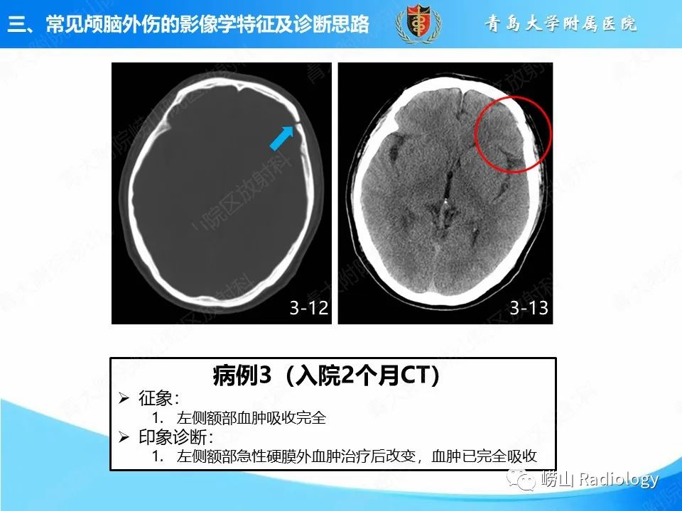 影像PPT - 【PPT】颅脑外伤性疾病-23