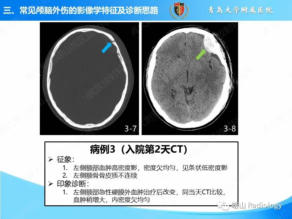 影像PPT - 【PPT】颅脑外伤性疾病-21