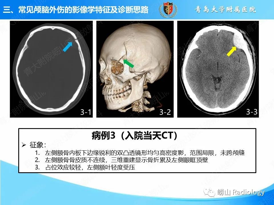 影像PPT - 【PPT】颅脑外伤性疾病-19