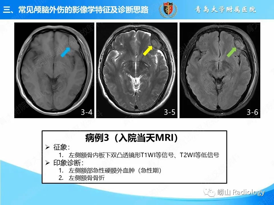 影像PPT - 【PPT】颅脑外伤性疾病-20