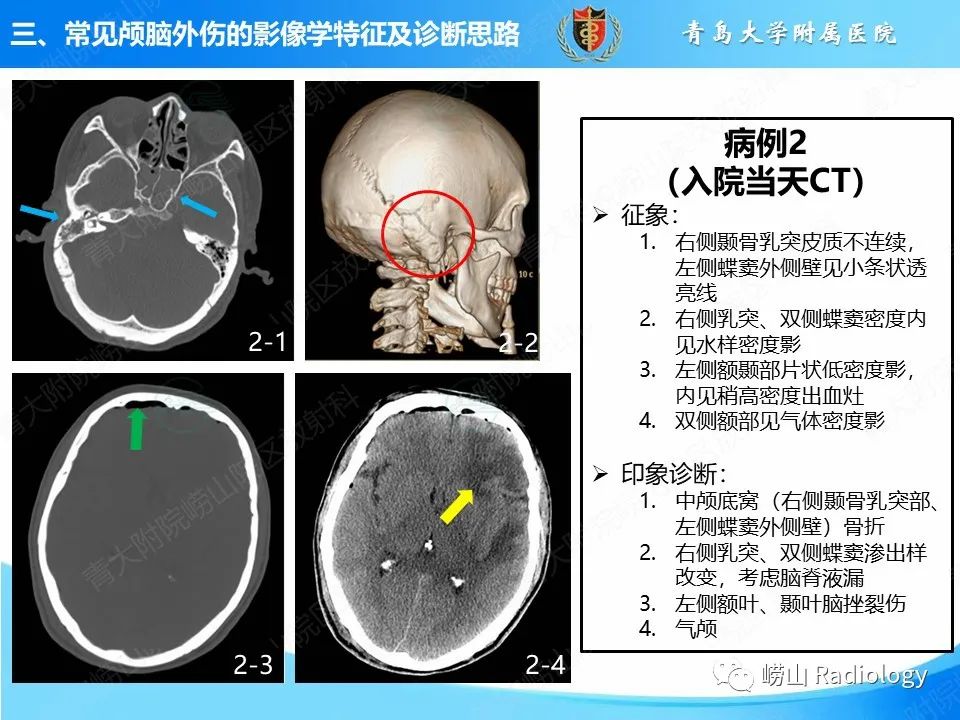 影像PPT - 【PPT】颅脑外伤性疾病-17