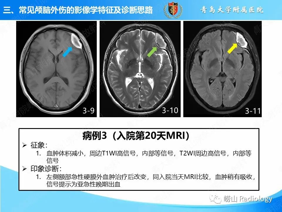 影像PPT - 【PPT】颅脑外伤性疾病-22