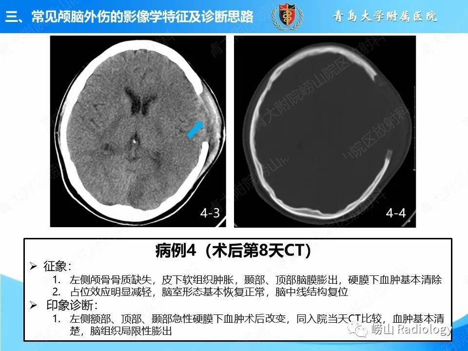 影像PPT - 【PPT】颅脑外伤性疾病-26