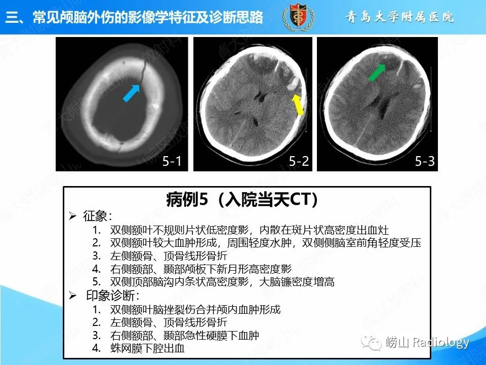 影像PPT - 【PPT】颅脑外伤性疾病-29