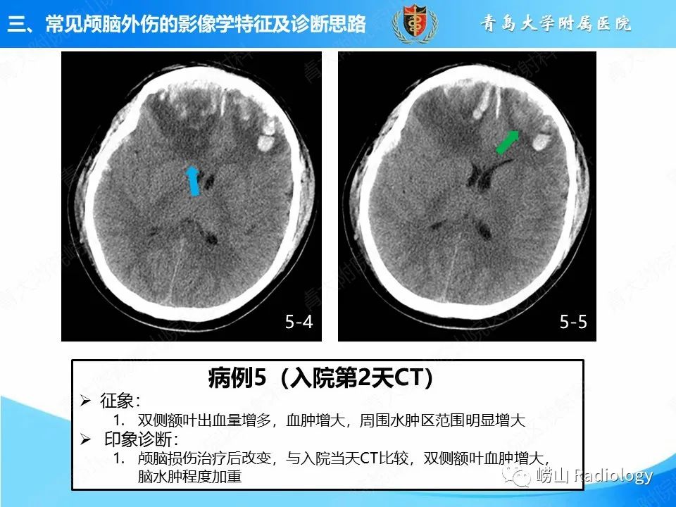 影像PPT - 【PPT】颅脑外伤性疾病-30