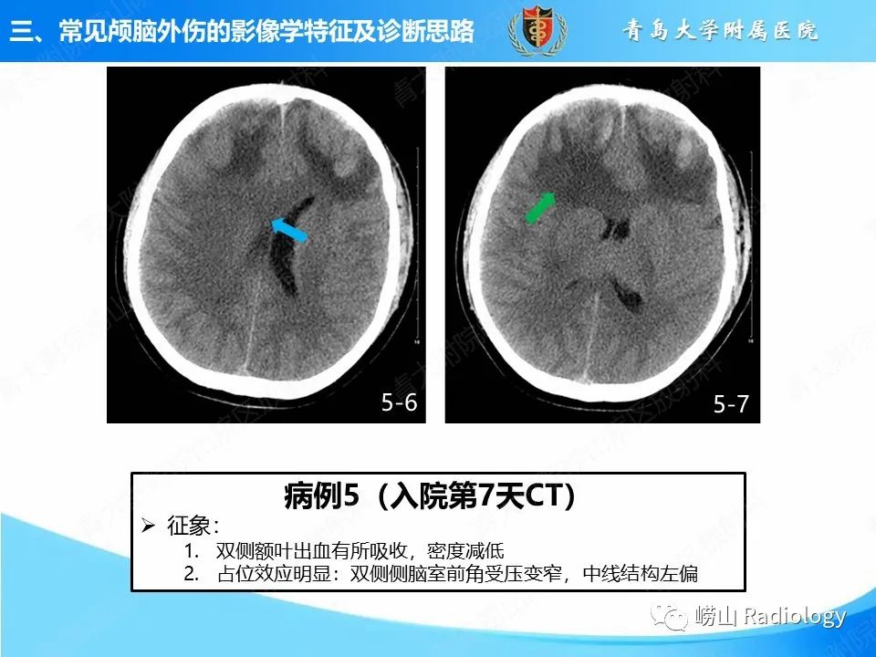 影像PPT - 【PPT】颅脑外伤性疾病-31