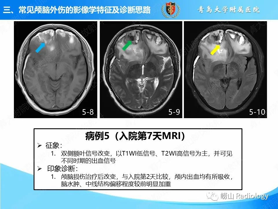 影像PPT - 【PPT】颅脑外伤性疾病-32