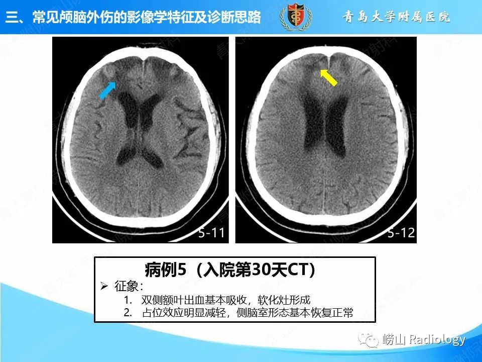 影像PPT - 【PPT】颅脑外伤性疾病-33
