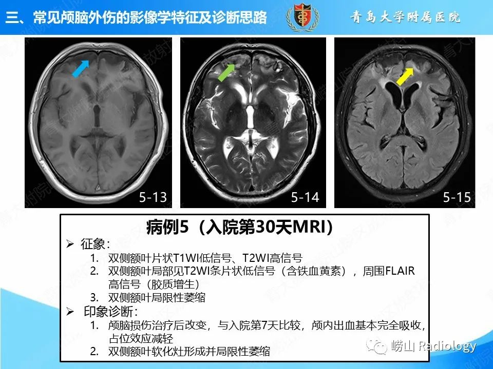影像PPT - 【PPT】颅脑外伤性疾病-34