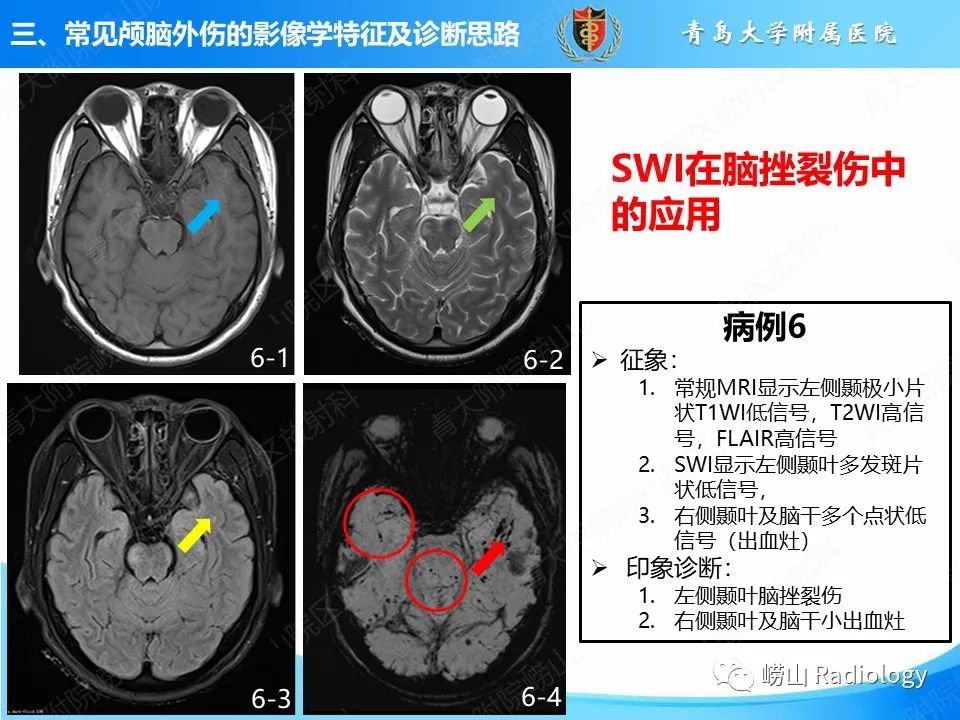 影像PPT - 【PPT】颅脑外伤性疾病-35