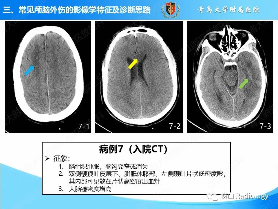 影像PPT - 【PPT】颅脑外伤性疾病-37