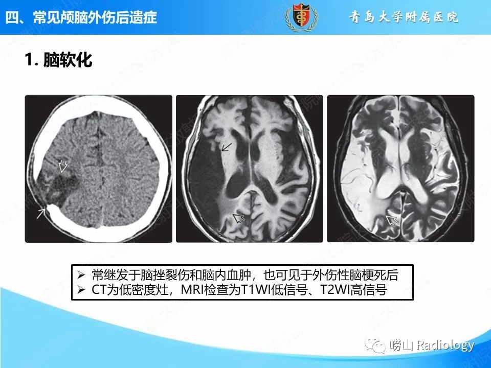 影像PPT - 【PPT】颅脑外伤性疾病-41