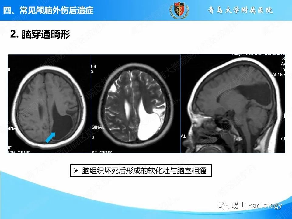 影像PPT - 【PPT】颅脑外伤性疾病-42