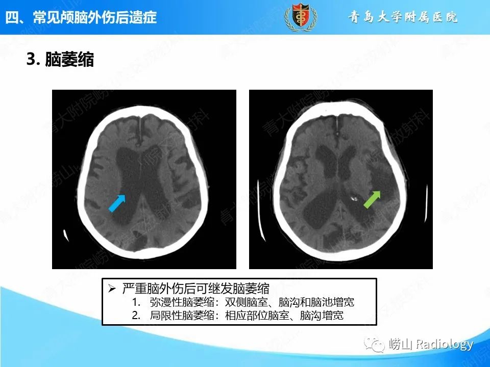 影像PPT - 【PPT】颅脑外伤性疾病-43