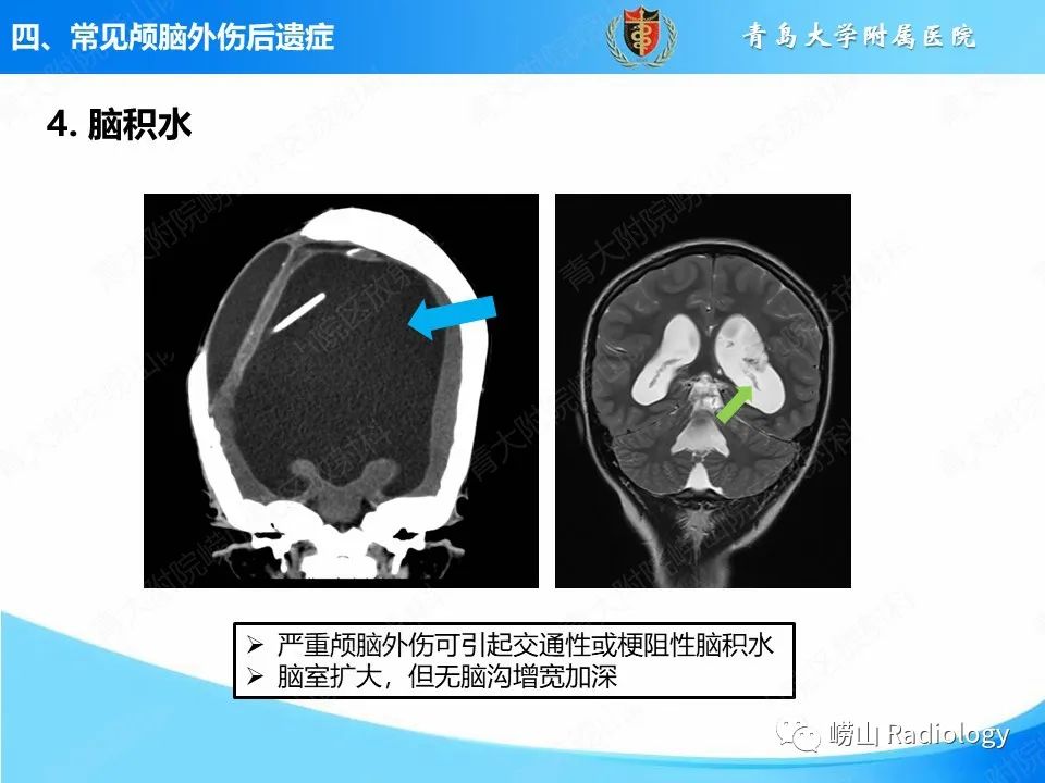 影像PPT - 【PPT】颅脑外伤性疾病-44