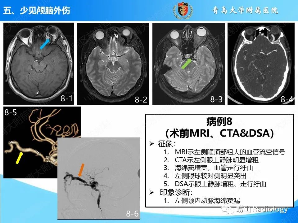 影像PPT - 【PPT】颅脑外伤性疾病-46