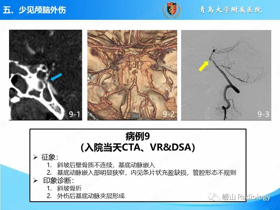 影像PPT - 【PPT】颅脑外伤性疾病-49