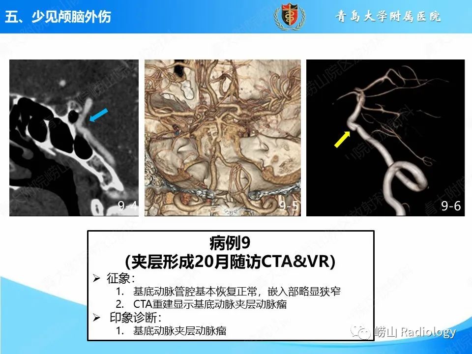 影像PPT - 【PPT】颅脑外伤性疾病-50