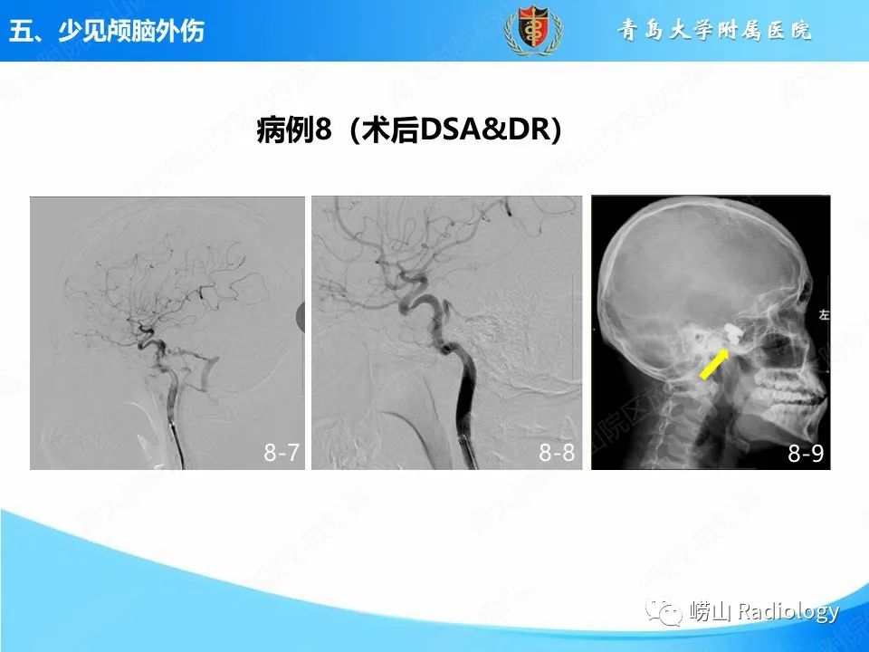 影像PPT - 【PPT】颅脑外伤性疾病-47