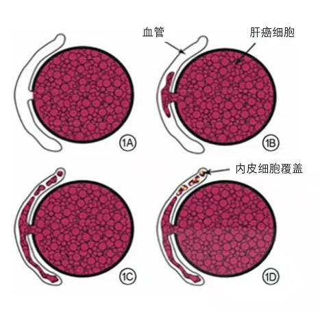 影像PPT - 影像学对肝细胞肝癌微血管侵犯的相关研究进展与展望-1