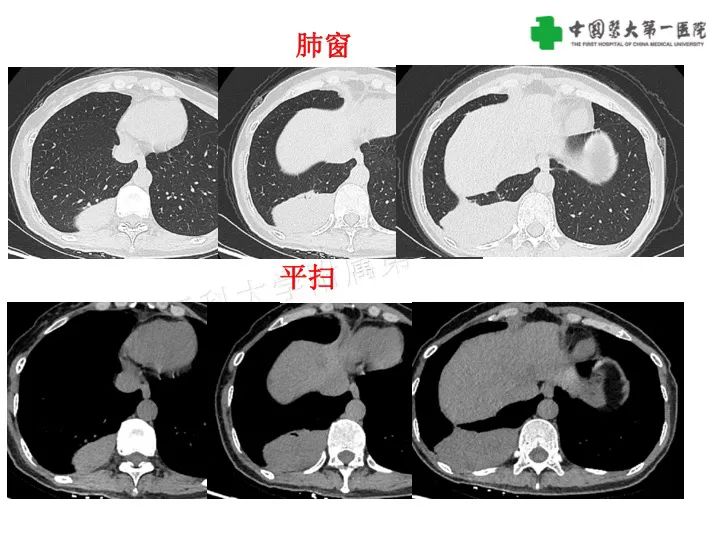 影像PPT - 【病例】胸膜孤立性纤维瘤1例CT影像-3