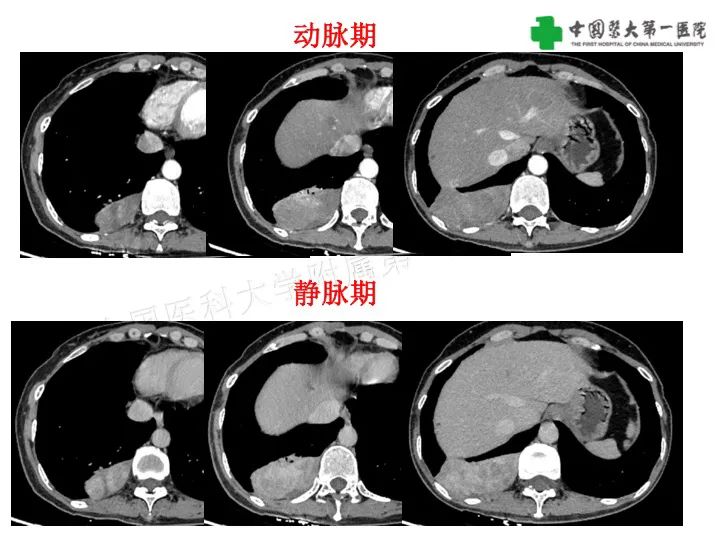 影像PPT - 【病例】胸膜孤立性纤维瘤1例CT影像-4