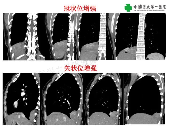 影像PPT - 【病例】胸膜孤立性纤维瘤1例CT影像-5
