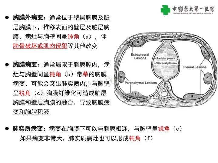 影像PPT - 【病例】胸膜孤立性纤维瘤1例CT影像-9