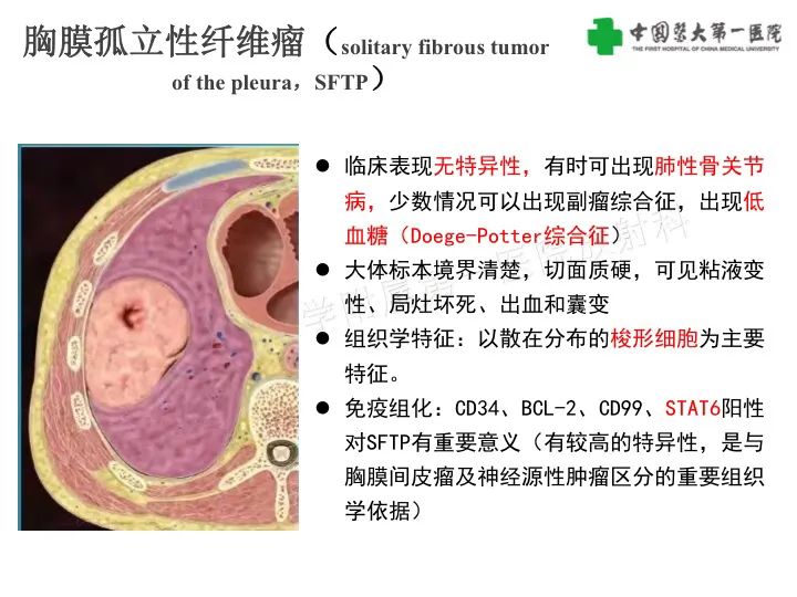 影像PPT - 【病例】胸膜孤立性纤维瘤1例CT影像-12