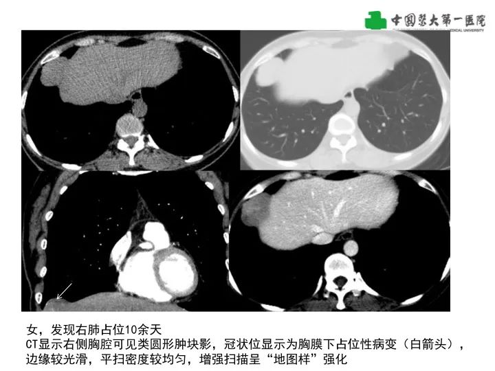 影像PPT - 【病例】胸膜孤立性纤维瘤1例CT影像-17