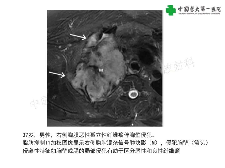 影像PPT - 【病例】胸膜孤立性纤维瘤1例CT影像-19