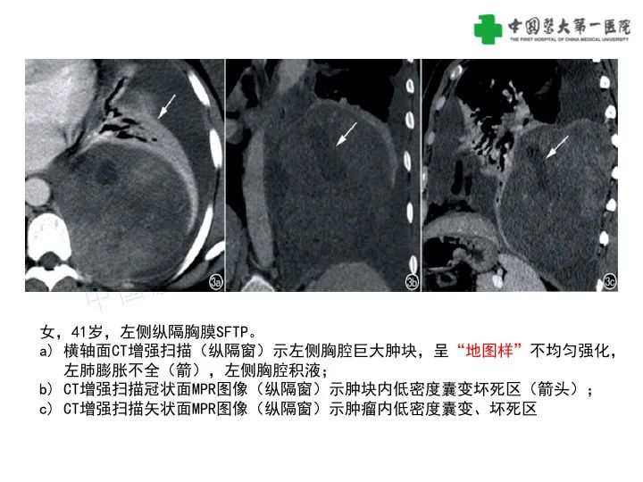 影像PPT - 【病例】胸膜孤立性纤维瘤1例CT影像-16