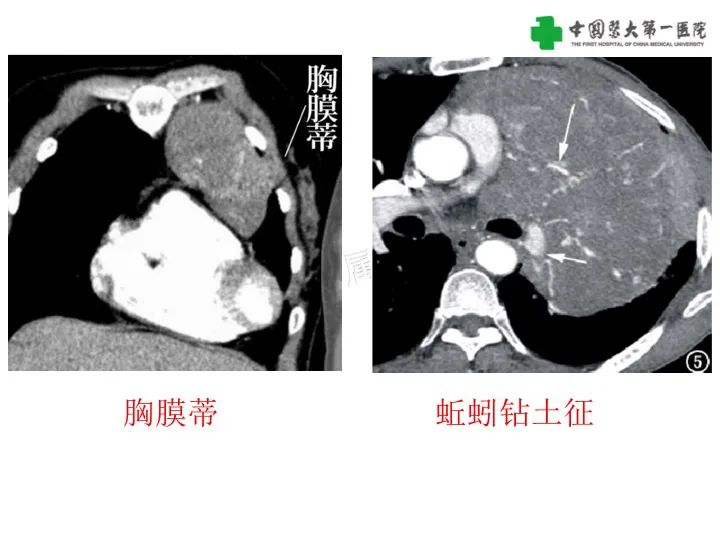 影像PPT - 【病例】胸膜孤立性纤维瘤1例CT影像-15