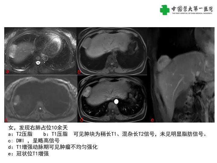 影像PPT - 【病例】胸膜孤立性纤维瘤1例CT影像-18