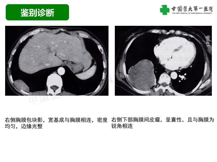 影像PPT - 【病例】胸膜孤立性纤维瘤1例CT影像-23