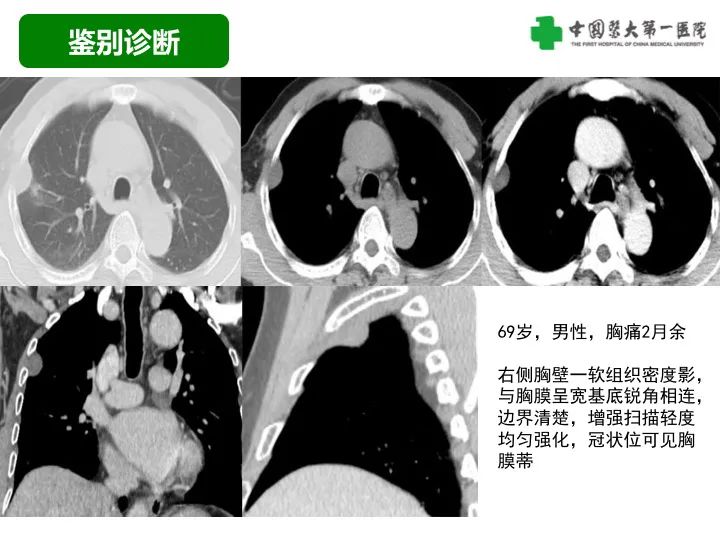 影像PPT - 【病例】胸膜孤立性纤维瘤1例CT影像-24