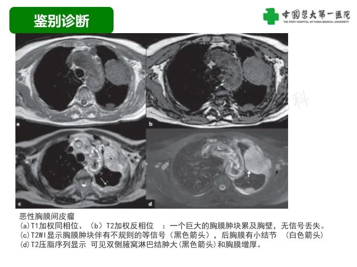 影像PPT - 【病例】胸膜孤立性纤维瘤1例CT影像-25